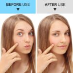 Pimple Popper Tool Kit Blackhead Remover Tools (5 Piece Kit), Professional Stainless Black Head Remover for face, Risk Free Treatment Pimple Extractor with Tweezers - Image 7